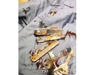 Surgeon extracts keys, knife, and nail cutters from man's stomach