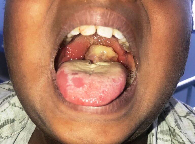 diphtheria